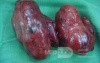 Toxic Goiter- total thyriodectomy1