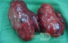 Toxic Goiter- total thyriodectomy1