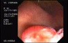 Tubulo - Villous Adenoma - Endoscopy (24 of 28)