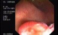 Tubulo - Villous Adenoma - Endoscopy (24 of 28)