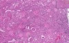 Diabetic Glomerulosclerosis