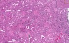 Diabetic Glomerulosclerosis