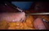 Laparoscopic Gastric Bypass - Part 1