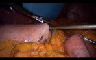 Laparoscopic Gastric Bypass - Part 1