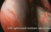 Nasal Polyposis - FESS 