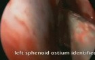 Nasal Polyposis - FESS 