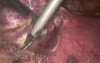 VATS thymoma removal