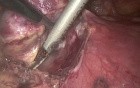 VATS thymoma removal