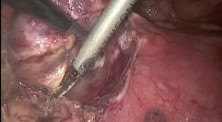 VATS thymoma removal
