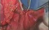 Gastric Cancer Surgery - Subtotal Proximal Gastrectomy