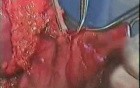 Gastric Cancer Surgery - Subtotal Proximal Gastrectomy