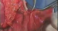 Gastric Cancer Surgery - Subtotal Proximal Gastrectomy