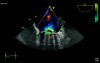 Mechanical Mitral Regurgitation