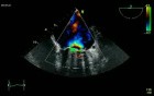 Mechanical Mitral Regurgitation