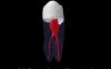 Mandibular First Premolar - Root Canal Anatomy - 3