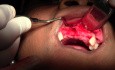 Extraction & Debridement - Maxillary Bone Grafting #7-8-10 Sites