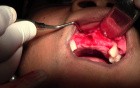 Extraction & Debridement - Maxillary Bone Grafting #7-8-10 Sites