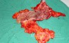 Severe case of Ischemic Colitis (16 of 19)