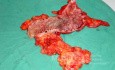 Severe case of Ischemic Colitis (16 of 19)