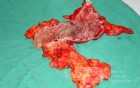 Severe case of Ischemic Colitis (16 of 19)