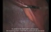 Laparoscopic Abdominal Hernia Repair with SILS® Port - part 1