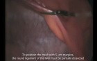 Laparoscopic Abdominal Hernia Repair with SILS® Port - part 1