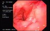 Duodenal Ulcer and Bleeding (3 of 4)