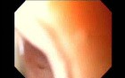 Massive Epistaxis - Second Absolute Alcohol Ablation -4/8