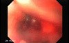 Synchronous Cancer (Gastric and Esophageal) - Assessment of the Superior Esophageal Sphincter