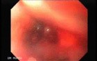 Synchronous Cancer (Gastric and Esophageal) - Assessment of the Superior Esophageal Sphincter