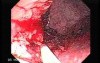 Tubulo - Villous Rectal Adenoma - Endoscopy (14 of 35)