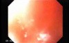 Squamous cell carcinoma of the larynx (3 of 4)