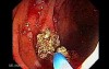Giant Tubulo - Villous Adenoma (6 of 17)