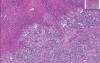 Kidney: Infarct, Congestion, Liver: Infarct, Congestion, Metastatic Pancreatic Carcinoma, Heart: Myocardial Infarct, Mural Thrombus, Fibrinous Pericarditis, Self-Learning Module, Hemodynamic Disorders