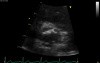 Coronary Artery Calcification - Aortic Cuspid of Right Coronary Artery