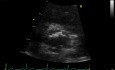 Coronary Artery Calcification - Aortic Cuspid of Right Coronary Artery