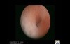 Proliferative Polipoid Like Endometrium 