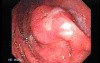 Early Gastric Cancer - Endoscopy (6 of 21)