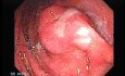 Early Gastric Cancer - Endoscopy (6 of 21)