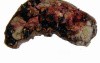 Gallbladder Adenocarcinoma and litiasis (6 of 13)