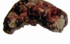 Gallbladder Adenocarcinoma and litiasis (6 of 13)