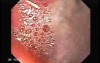 Scirrhous Gastric Carcinoma - Endoscopy (10 of 47)