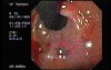 Mallory-Weiss Syndrome - Slight Bleeding Around Blood Clot