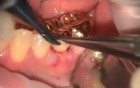 Functional Grafting #19B