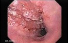 Esophageal Squamous Cell Carcinoma - 75 Year-Old Female with Progressive Dysphagia