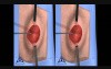Open Hernia Procedure - 3D Stereographic Animation