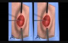 Open Hernia Procedure - 3D Stereographic Animation