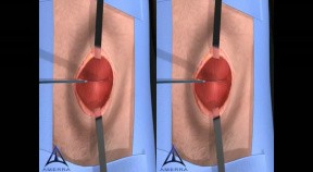 Open Hernia Procedure - 3D Stereographic Animation