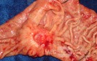 Diffuse Adenocarcinoma with signet ring cells (12 of 18)