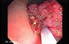 Tubulo - Villous Rectal Adenoma - Endoscopy (5 of 35)